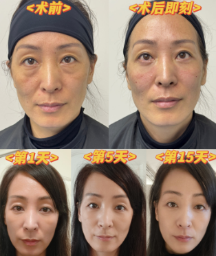 去眼袋手术
