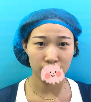 去眼袋手术