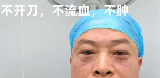 去眼袋手术
