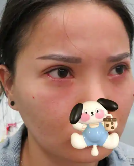 去眼袋手术