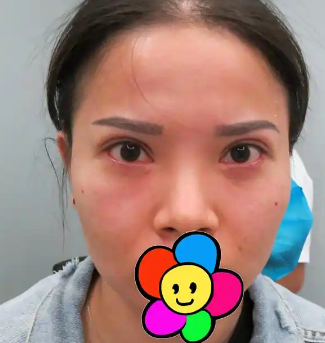 去眼袋手术