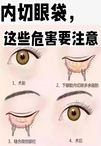 去眼袋手术