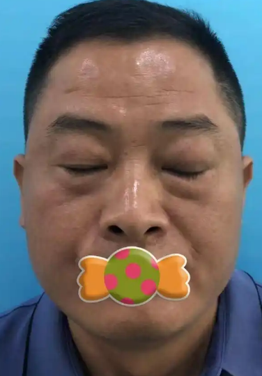 去眼袋手术