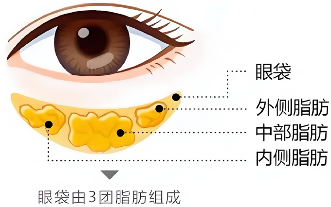 去眼袋手术