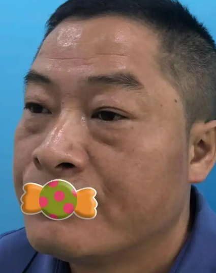 去眼袋手术