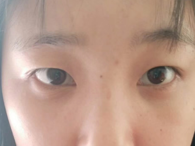 去眼袋手术