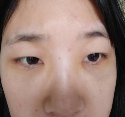 去眼袋手术