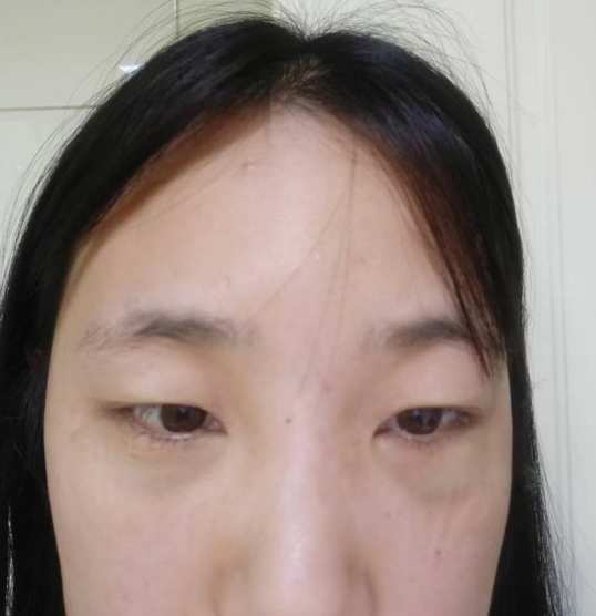 去眼袋手术