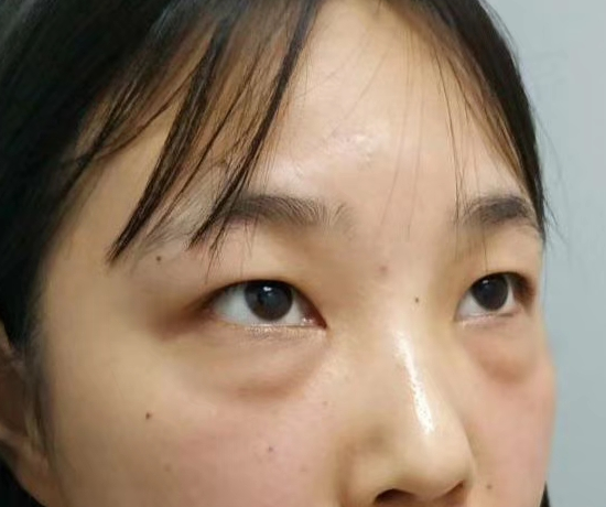 去眼袋手术