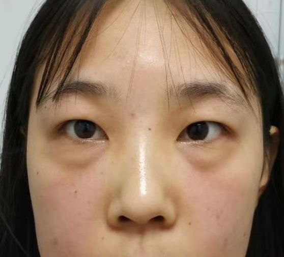 去眼袋手术