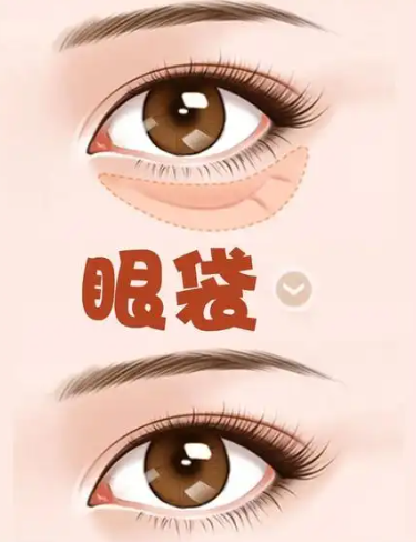 去眼袋手术