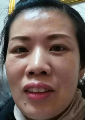 去眼袋手术