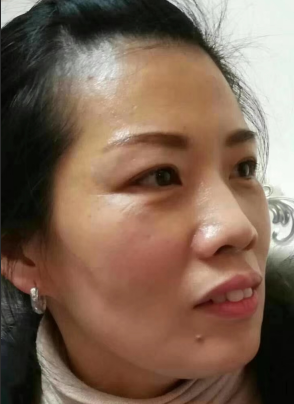 去眼袋手术
