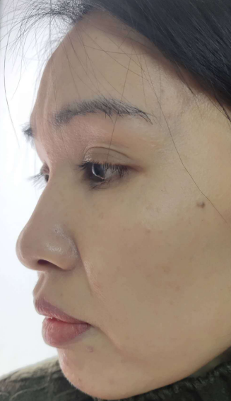 去眼袋手术