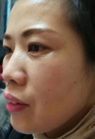 去眼袋手术