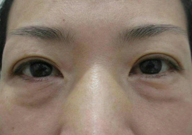 去眼袋手术