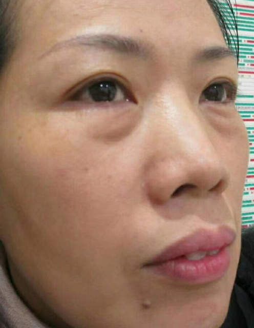 去眼袋手术