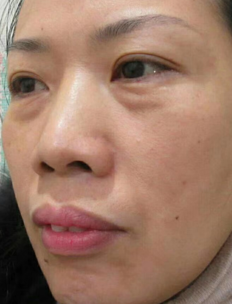 去眼袋手术