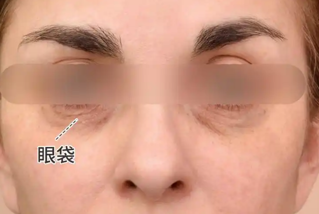 去眼袋手术
