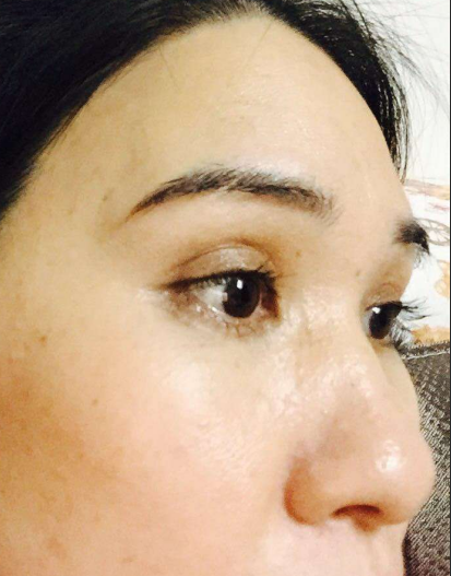 去眼袋手术