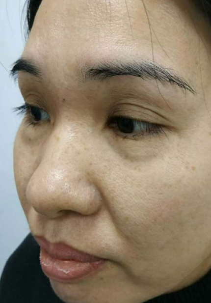 去眼袋手术