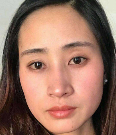 去眼袋手术