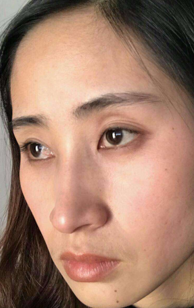 去眼袋手术
