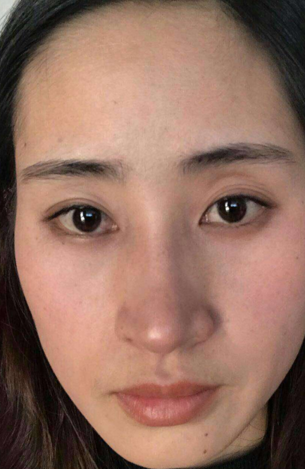去眼袋手术
