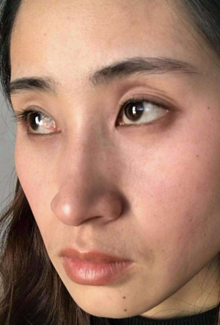 去眼袋手术
