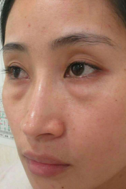 去眼袋手术
