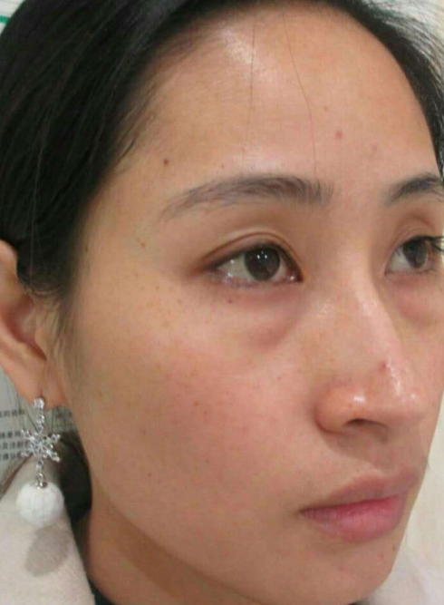 去眼袋手术