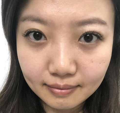 去眼袋手术