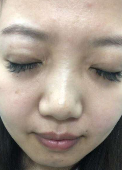 去眼袋手术