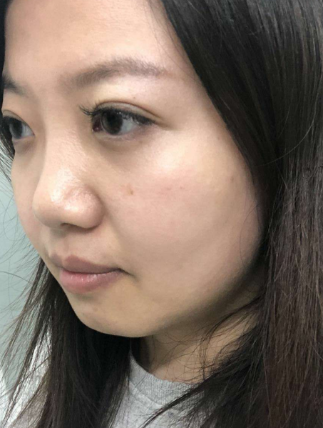 去眼袋手术