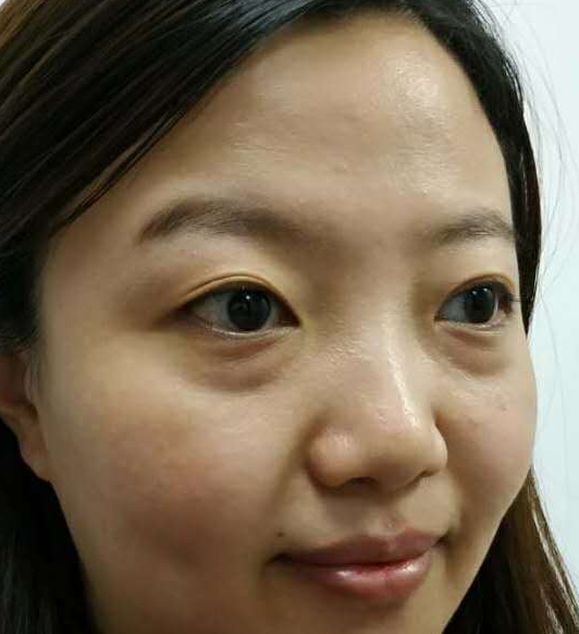 去眼袋手术