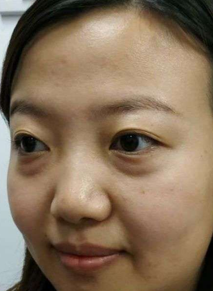 去眼袋手术