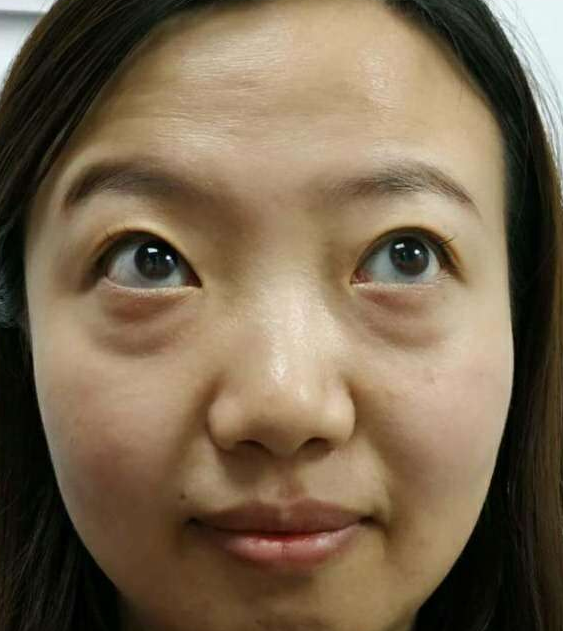 去眼袋手术