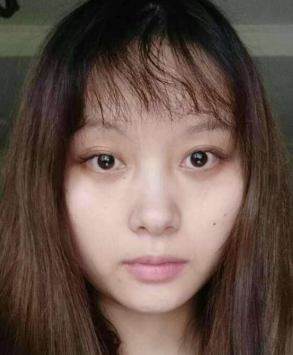去眼袋手术