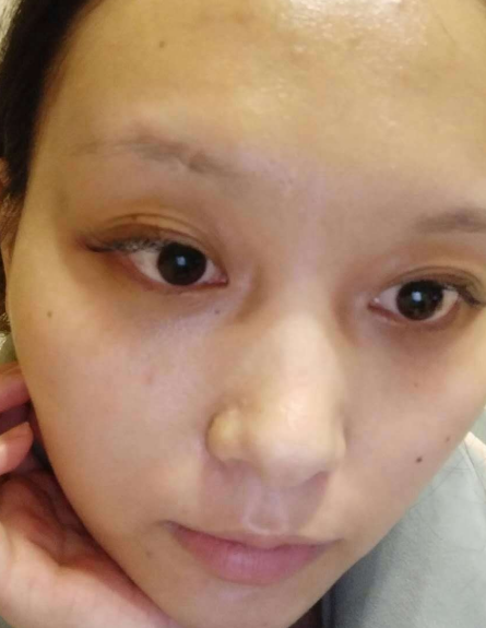 去眼袋手术