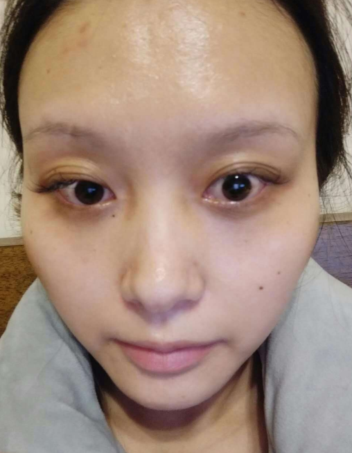 去眼袋手术