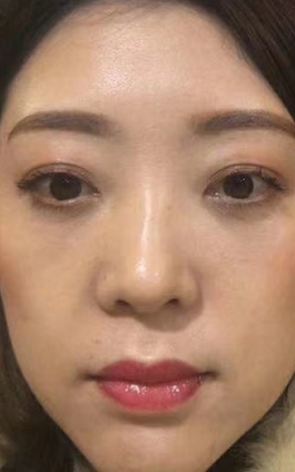 去眼袋手术