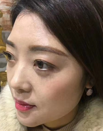 去眼袋手术