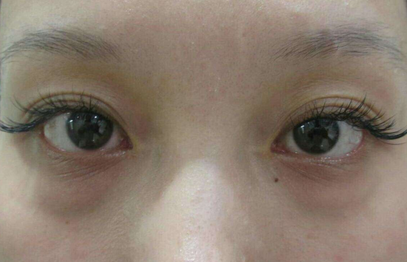 去眼袋手术