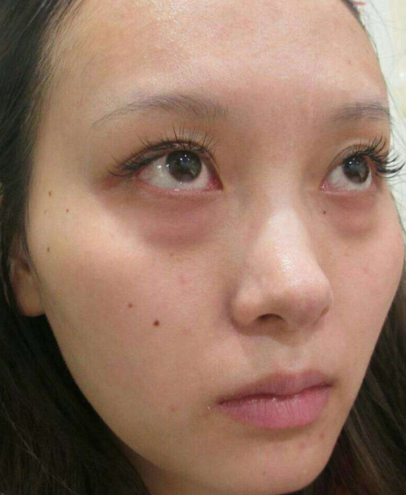 去眼袋手术