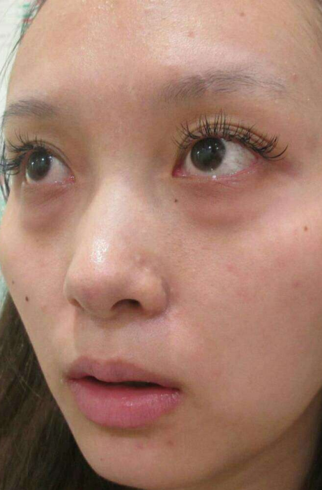 去眼袋手术