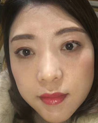 去眼袋手术
