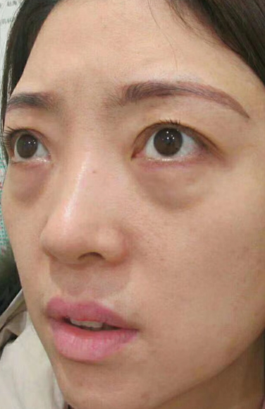 去眼袋手术