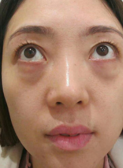 去眼袋手术