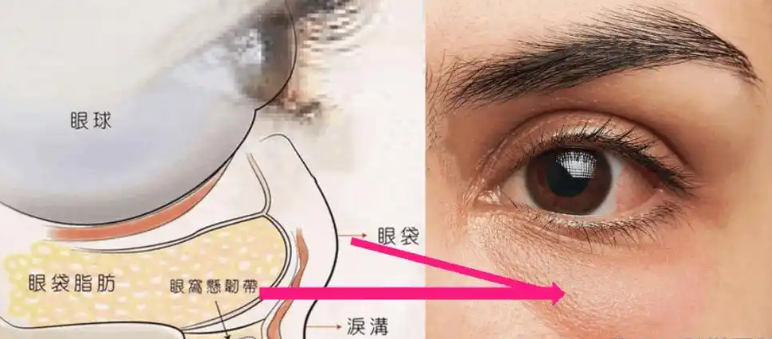 去眼袋手术