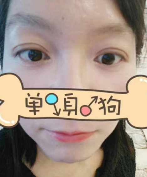 去眼袋手术
